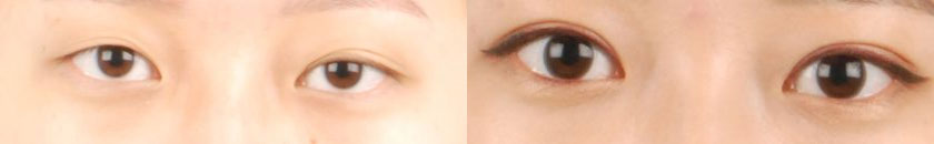 Asian female in her 20s with asymmetrical eyes and ptosis (droopy eyelid) underwent Asian double eyelid surgery (Asian blepharoplasty) and ptosis correction. The after photo shows defined double eyelid creases, improved eye symmetry, and elevated eyelids for larger eyes. Note the iris is more visible as well.
   

