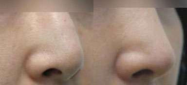 Mid 30s female patient’s results before and after awake revision nose surgery, showing a more defined nose shape and balanced prominence of nasal tip.
   

