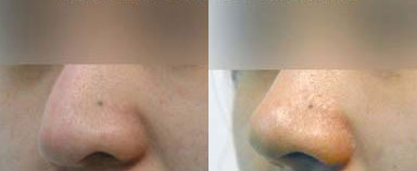 Female patient in her 40s with fully healed results after awake revision rhinoplasty. A more petit nose with straight dorsum matches patient’s facial features.
   

