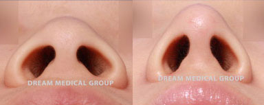 Results of female rhinoplasty showing improvement from flattened nose for a more distinct profile. Entire nose procedure was an awake surgery, improving safety and recovery.
   

