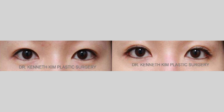 Female patient in her 20s underwent awake double eyelid surgery (Asian blepharoplasty) and awake lateral cathoplasty. The lateral canthoplasty subtly widened the outer corners of the eyes and complemented the natural-looking, defined double eyelid folds.
   

