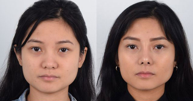 Female patient in early 30s who underwent awake Asian rhinoplasty to increase prominence of tip and narrowing of nasal width.
   

