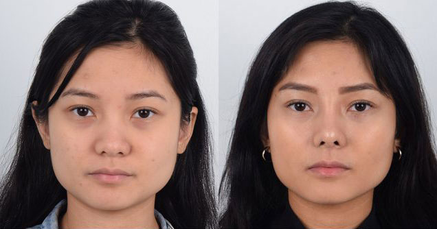 Female patient in early 30s who underwent awake Asian rhinoplasty to increase prominence of tip and narrowing of nasal width.