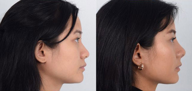 Female patient in early 30s who underwent awake Asian rhinoplasty to increase prominence of tip and narrowing of nasal width.
   

