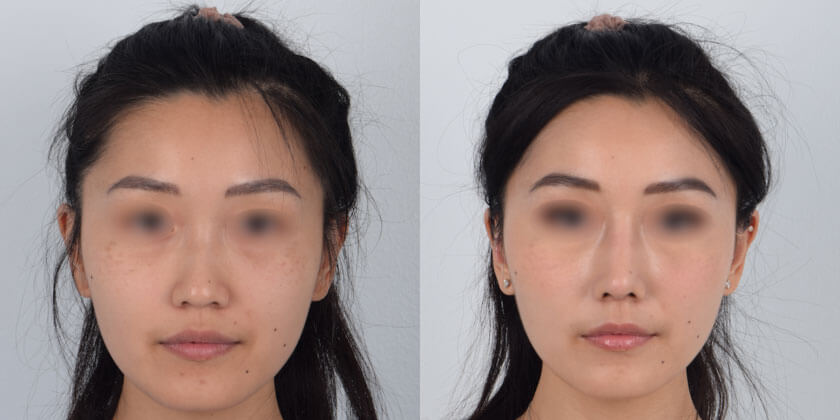 Asian Female, Nose Surgery, Age:18 - 25