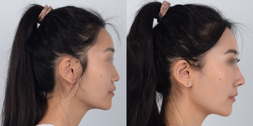 Asian female in her 20s underwent rhinoplasty augmentation to achieve a higher bridge and sharper tip nose. Dr. Kim utilized the patient’s rib cartilage to define her nose shape. He performed the procedure using local anesthesia so that the patient was fully awake during surgery and did not need to go under. She recovered quickly and the after photos show a defined, beautifully enhanced nose that complements her face.
   

