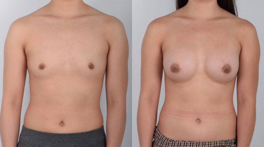 Female, Breast Augmentation, Age:18 - 25