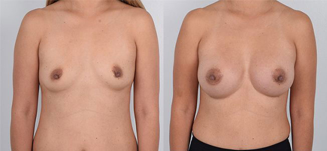 Female, Breast Augmentation, Age:26 - 30
