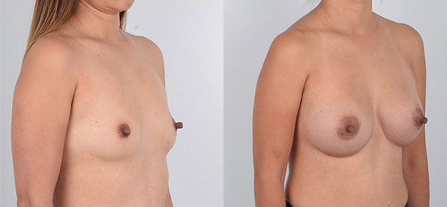 Female in her 20s underwent awake breast augmentation surgery with Dr. Kenneth Kim. His expertise in the use of local anesthesia for breast augmentation allows the patient to be fully awake during surgery. Patients are not subject to the well-known risks and complications of general anesthesia (e.g. blood clots, cardiac arrest, permanent memory loss). By undergoing awake breast augmentation, the patient was able to recover quickly and safely without any side effects. The after photos show enhanced breasts that are fuller, balanced, and proportionate to her frame.
   

