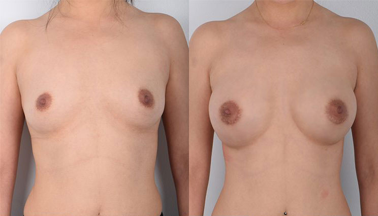 Female, Breast Augmentation, Age:18 - 25