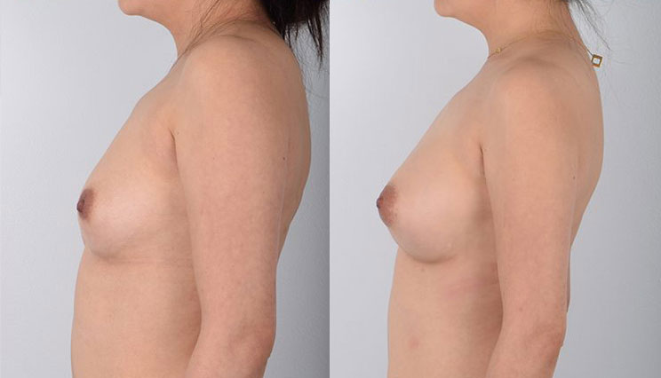 Female in her 20s was seeking the safest breast augmentation with the least amount of risks. During her research, she found Dr. Kenneth Kim, the leading expert in awake breast augmentation surgery. He operates using local anesthesia so the patient is awake during the procedure and does not feel pain. This is the safest way to have breast enlargement surgery, ensuring the fastest recovery possible with no need for narcotic pain medications. Right after her procedure, the patient was able to walk out of the operating room unassisted and make a quick recovery with her aesthetic and safety goals achieved.
   

