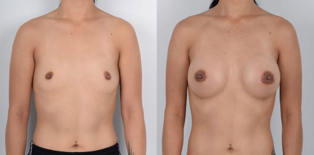 Female, Breast Augmentation, Age:26 - 30