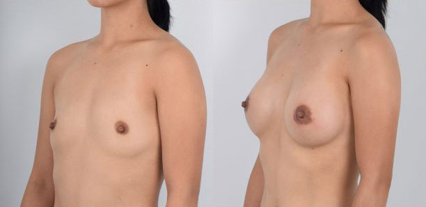 Female in her 20s wanted larger, full breasts to enhance her figure and shape. Breast augmentation surgery is an effective way for those with naturally small breasts to achieve volume and projection in their breasts. Dr. Kim performs breast augmentation using local anesthesia which is the safest way to perform this surgery. The patient was fully awake during the procedure and did not experience discomfort or pain. The use of awake/local anesthetic ensures the utmost patient safety and well-being and results in the quickest recovery with no downtime.
   

