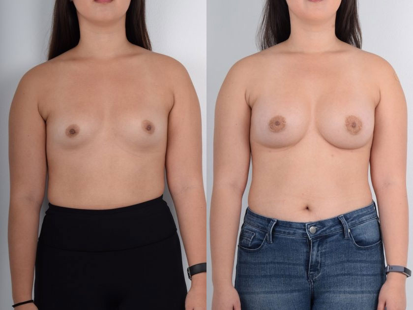 Caucasian Female, Breast Augmentation, Age:18 - 25