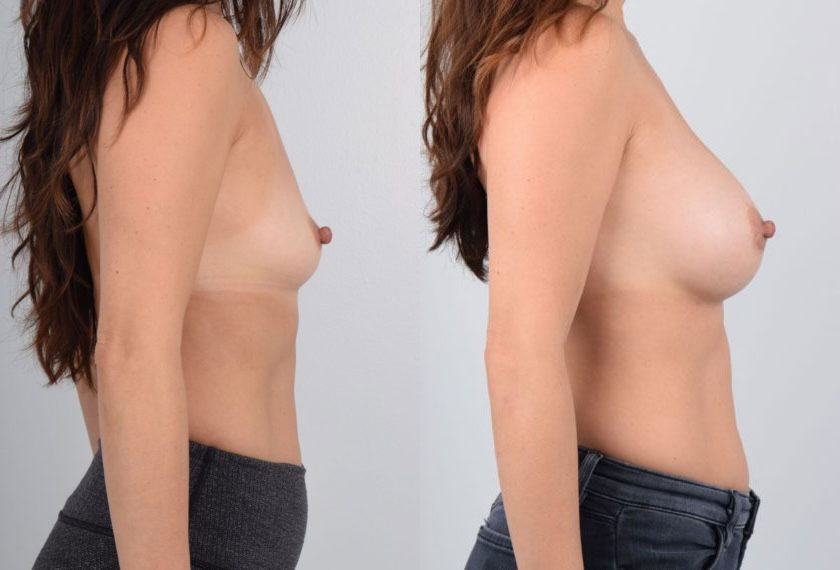 Female in her 20s wanted breast augmentation surgery to increase the size and shape of her breasts. She consulted with Dr. Kim because he performs this procedure using local anesthesia, which is the safest way to have breast enlargement surgery. She was fully awake during surgery and was able to relax without feeling any discomfort. The use of local anesthesia ensured a fast recovery with no downtime. The after photos show natural-looking, fuller breasts that are proportionate to the patient’s frame and the placement of the implants also created optimal cleavage.
   

