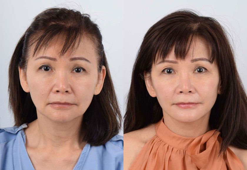 Asian Female, Facelift, Age:61 - 65