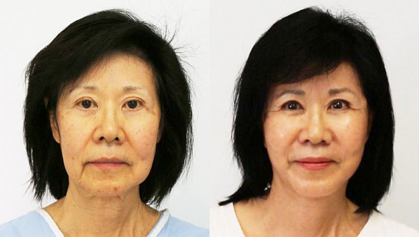  Female, Facelift, Age:51 - 60