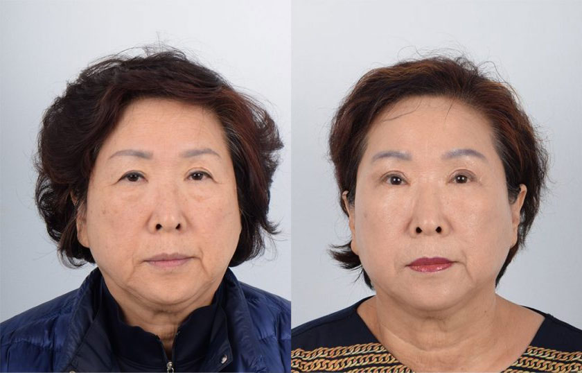  Female, Facelift, Age:51 - 60