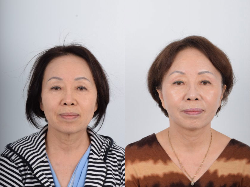 Asian Female, Facelift, Age:51 - 60