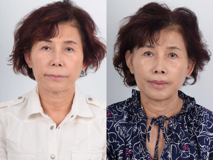 Female Asian patient in her 50s before and after an awake lip lift surgery. Patient was concerned about the thinness of her upper lip and wanted to make minor adjustments for fuller lips and to reduce the distance between the base of the nose and upper lip. Note in the after photo, the gentle curve of the upper lip that enhances the lip volume and shape. Patient recovered quickly from the surgery and had no complications.
   

