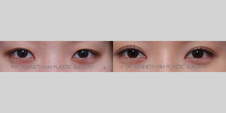 Asian female in her 20s with subtle double eyelids received Asian double eyelid surgery (Asian upper blepharoplasty) to enhance and enlarge her double eyelid folds. Based on the structure and anatomy of the patient’s eyelids and the look she was trying to achieve, the procedure was customized to create an ideal fold that best suited her overall eye shape. Note the conversion from infold to subtle out-fold double eyelids.
   

