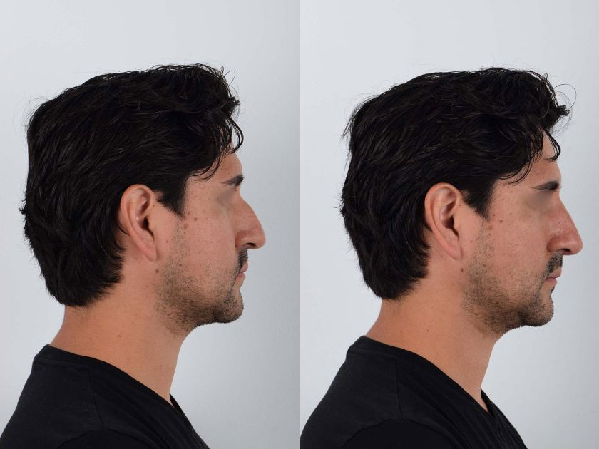 Mid 20s male patient before and after liquid/filler rhinoplasty, smoothing the bridge of the nose for a refined profile. Careful technique ensured a nose shape that met the patient’s goals and complemented their natural features.
   

