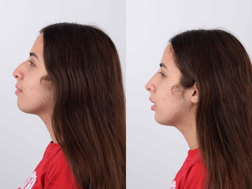 Female patient in her 20s before and after filler rhinoplasty treatment. The non-surgical treatment resulted in a refined nose profile that presents with a straight line from dorsum to tip. The results balance with the patient’s natural features and enhance her facial aesthetics.
   

