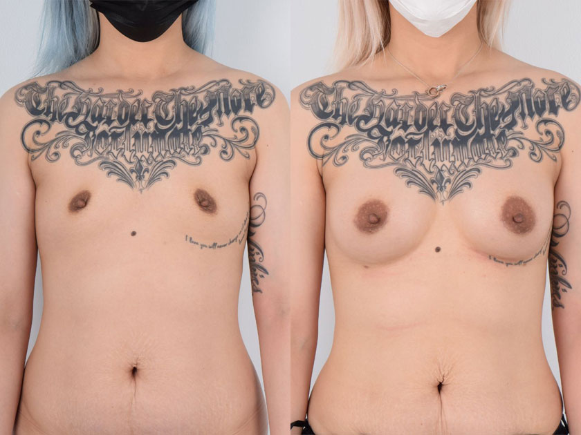 Female, Breast Augmentation, Age:18 - 25