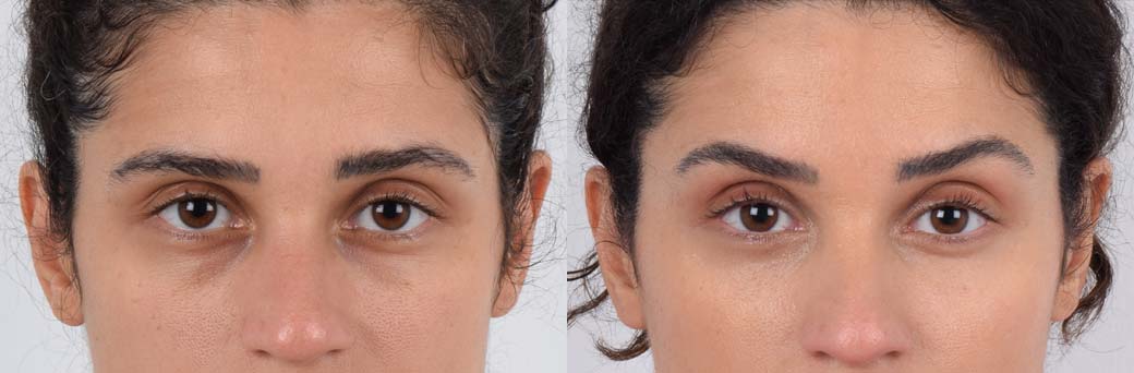 36 year old female had dark circles and under-eye bags which gave a tired appearance. She underwent lower blepharoplasty surgery where the fat in the lower eyelids was repositioned. The congested blood vessels causing the dark circles were also relieved during surgery. Note the after photo where the lower eye area is smooth and dark circles are no longer present, resulting in youthful and bright eyes.