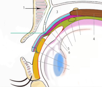 ptosis-2