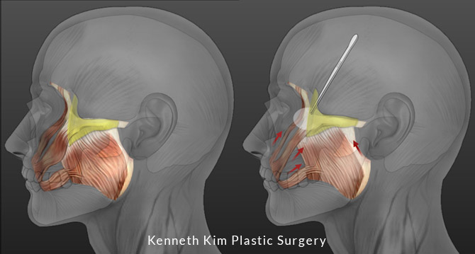 Image of re-elevates and stabilizes the soft tissue and muscles