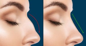 women rhinoplasty before and after stock image