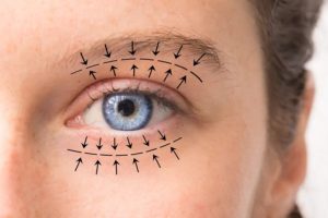 Arrows point in the direction of planned oculoplastic surgery stock image