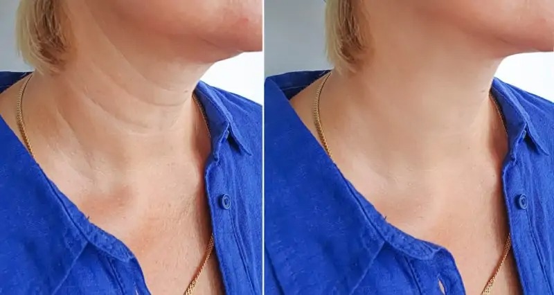 woman neck wrinkles before and after treatment stock image
