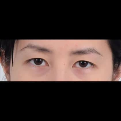 Eyelid Surgery Before & After Patient #5038