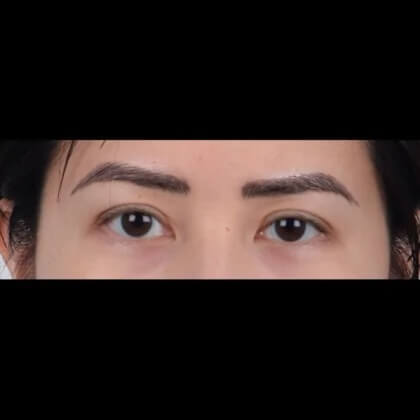 Eyelid Surgery Before & After Patient #5038