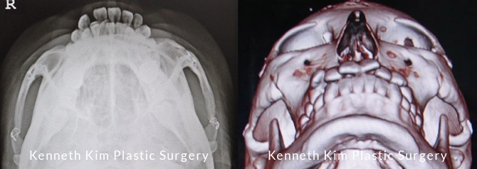 Image of the postoperative x-ray
