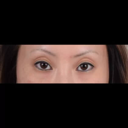 Eyelid Surgery Before & After Patient #5041