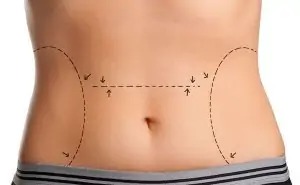 doctor draw lines with marker on patient belly stock photo