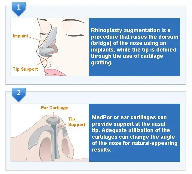 Rhinoplasty Augmentation techniques photo