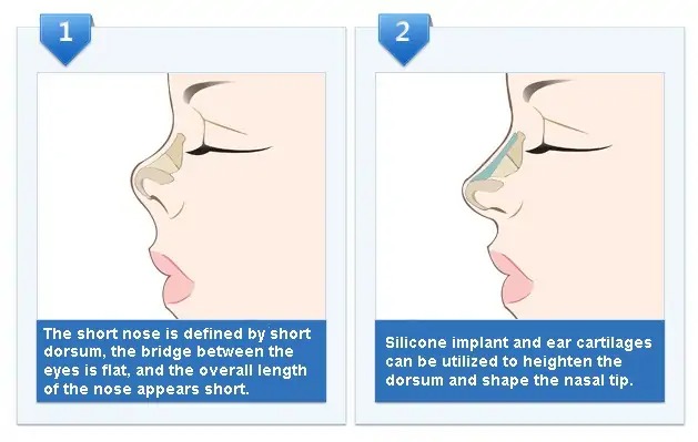 Short Nose Rhinoplasty sketch photo