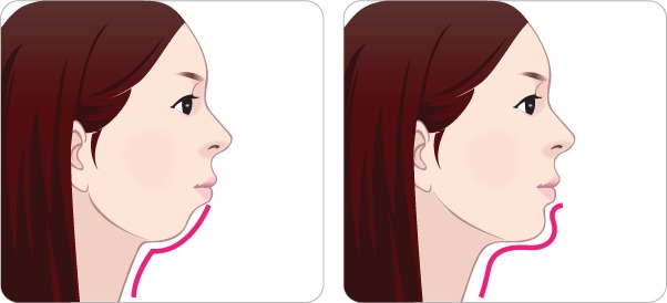 Chin Augmentation sketch stock image