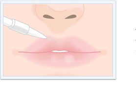 making botox injection in female lips sketch stock photo