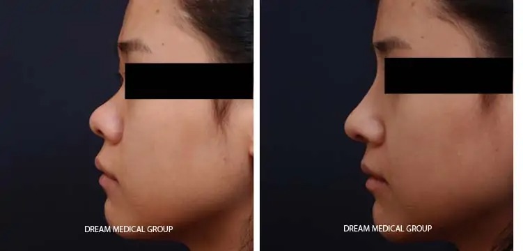 Korean Asian rhinoplasty before after picture